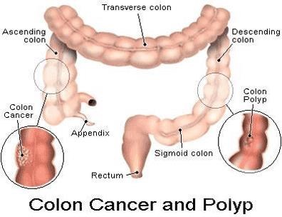 Ung thư ruột già (Colon cancer)