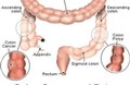 Ung thư ruột già (Colon cancer)