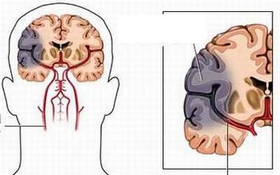 Biến chứng hạ đường máu