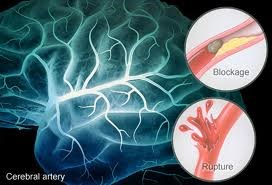 Chữa trị và phòng ngừa tai biến mạch máu não