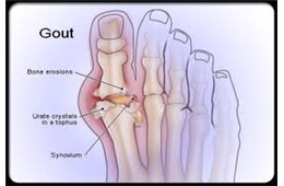 Bệnh Thống Phong (Gout)