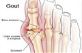 Bệnh Gout Đến Từ Đâu?