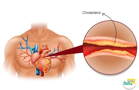 Cholesterol không phải là nguyên nhân gây ra bệnh tim
