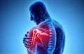 Điều trị bệnh thoái hóa khớp