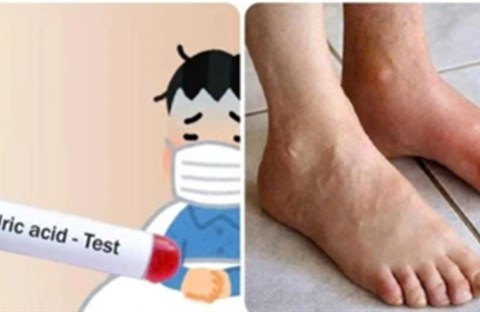 Axit uric là nguồn cơn gây ra nhiều bệnh nguy hiểm