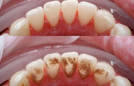 Lấy cao răng hữu hiệu - 5